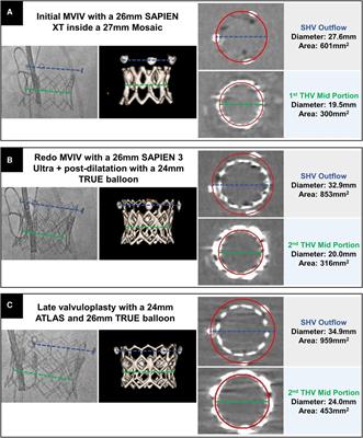 Case Report: Stretching the limits—late valvuloplasty for THV dysfunction following redo mitral valve-in-valve implantation